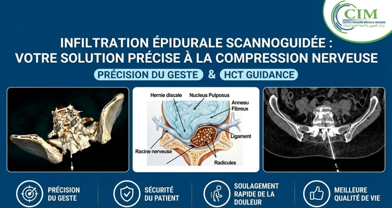 Infiltration Épidurale Scannoguidée à Inezgane | CIM Inezgane